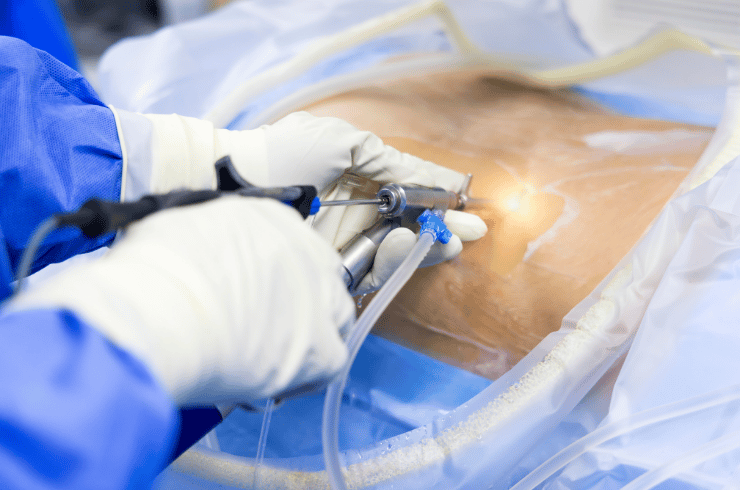 endo Spine Surgery